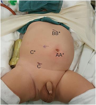 Comparing Robot-Assisted Laparoscopic Pyeloplasty vs. Laparoscopic Pyeloplasty in Infants Aged 12 Months or Less